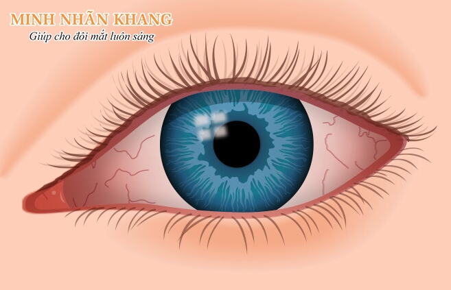 Khô mắt sau phẫu thuật lasik với biểu hiện đỏ, sưng, đau