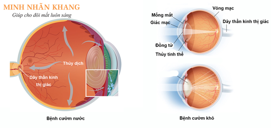 Cườm mắt bao gồm bệnh cườm nước và cườm khô