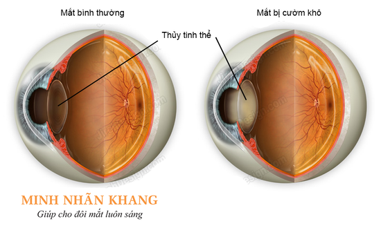 Đục thủy tinh thể, cườm khô, cườm đá, cườm hạt đều là một bệnh