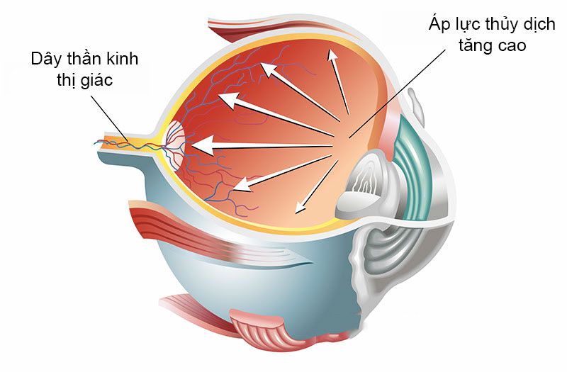 Tăng nhãn áp gây tổn thương dây thần kinh thị giác khiến mắt mờ dần