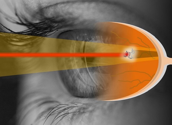 Chữa đục dịch kính bằng laser có thể gây biến chứng nguy hiểm cho mắt