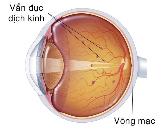 Đục dịch kính – nguyên nhân thường gặp gây hiện tượng mắt nhìn thấy chấm đen