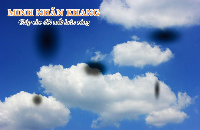 Đục thủy tinh thể là nguyên nhân hàng đầu khiến mắt bị ruồi bay