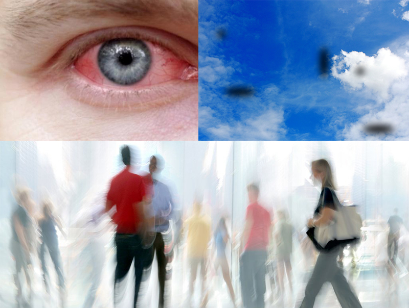 Mắt bị ruồi bay có thể gây giảm thị lực nghiêm trọng nếu không trị kịp thời