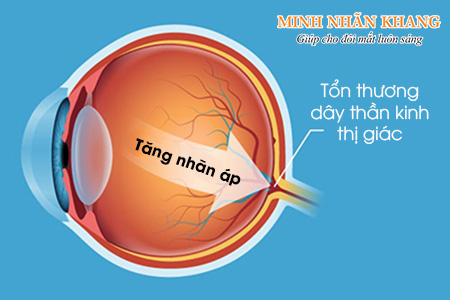 Bệnh cườm nước ở mắt có thể tổn thương dây thần kinh thị giác