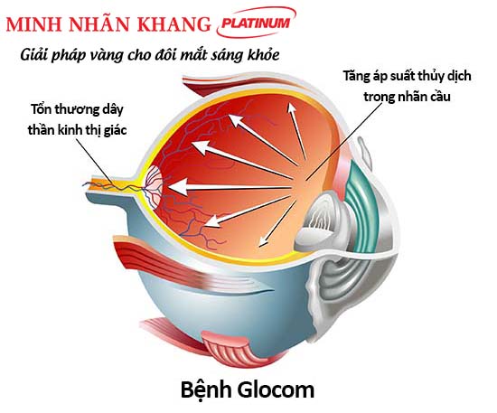 Bệnh Glocom ở mắt làm tổn thương các dây thần kinh thị giác