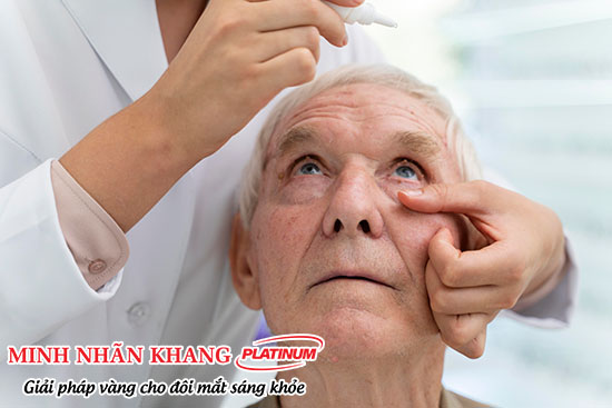 Thuốc điều trị tăng nhãn áp dạng nhỏ mắt là lựa chọn đầu tay của nhiều bác sĩ