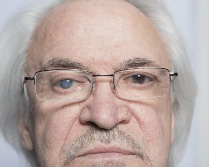 Mổ mắt thay thủy tinh thể khi thị lực quá kém