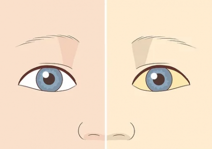 Mắt vàng nhìn nhòe có thể do đục thủy tinh thể hoặc nhiều bệnh khác gây ra