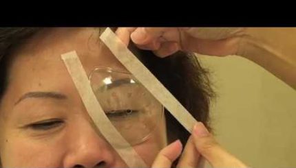 Mổ đục thủy tinh thể mắt phải, mắt trái vẫn có thể nhìn mờ