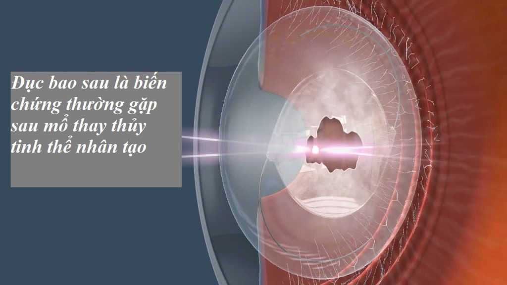 Đục bao sau là bệnh gì, có chữa khỏi được không