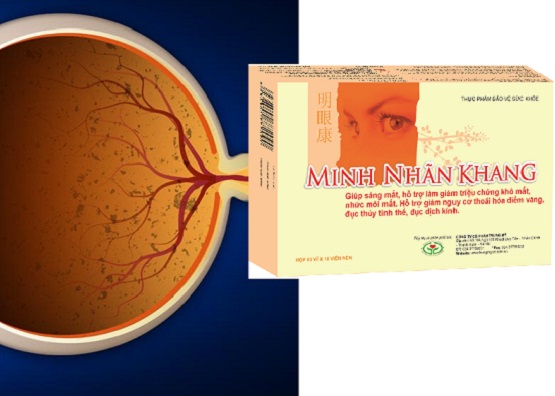 Viêm võng mạc sắc tố dùng Minh Nhãn Khang có được không