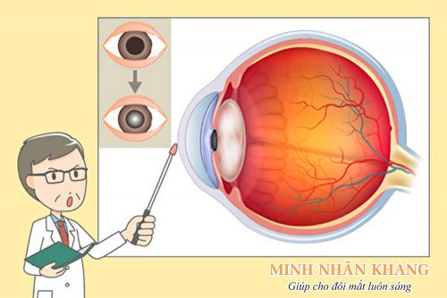 Ruồi bay vẩn đục dịch kính - Nguyên nhân và cách trị