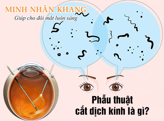 Phẫu thuật cắt dịch kính là gì? Có nguy hiểm không?