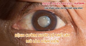 Bệnh cườm nước xảy ra khi chất lỏng trong mắt không thoát được ra ngoài