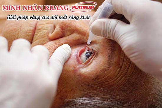 Thuốc nhỏ mắt điều trị bệnh cườm nước dễ dùng nhưng có thể gây kích ứng mắt