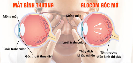 Glocom góc mở gây tổn thương thần kinh thị giác và dần dần làm mất thị lực
