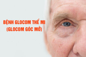 Glocom thể mi (Glocom góc mở) – Hiểu rõ bệnh để tránh mù lòa