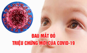 Đau mắt đỏ – Triệu chứng mới của biến thể Covid-19 XBB.1.16